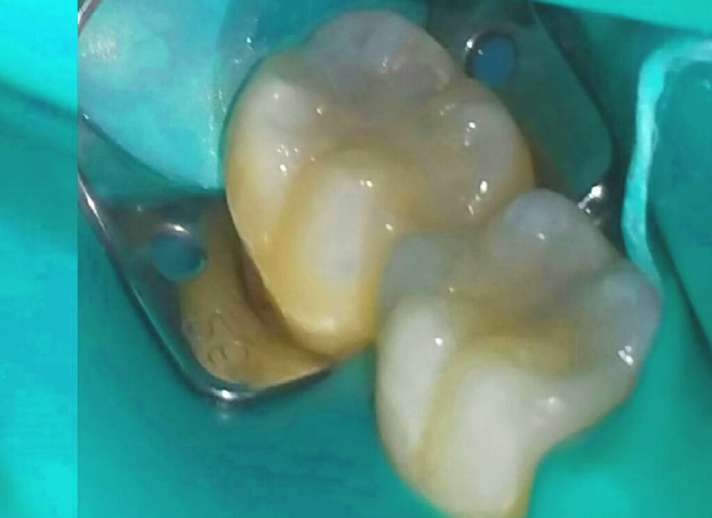 O que você precisar saber sobre restaurações dentárias | Dabi Atlante