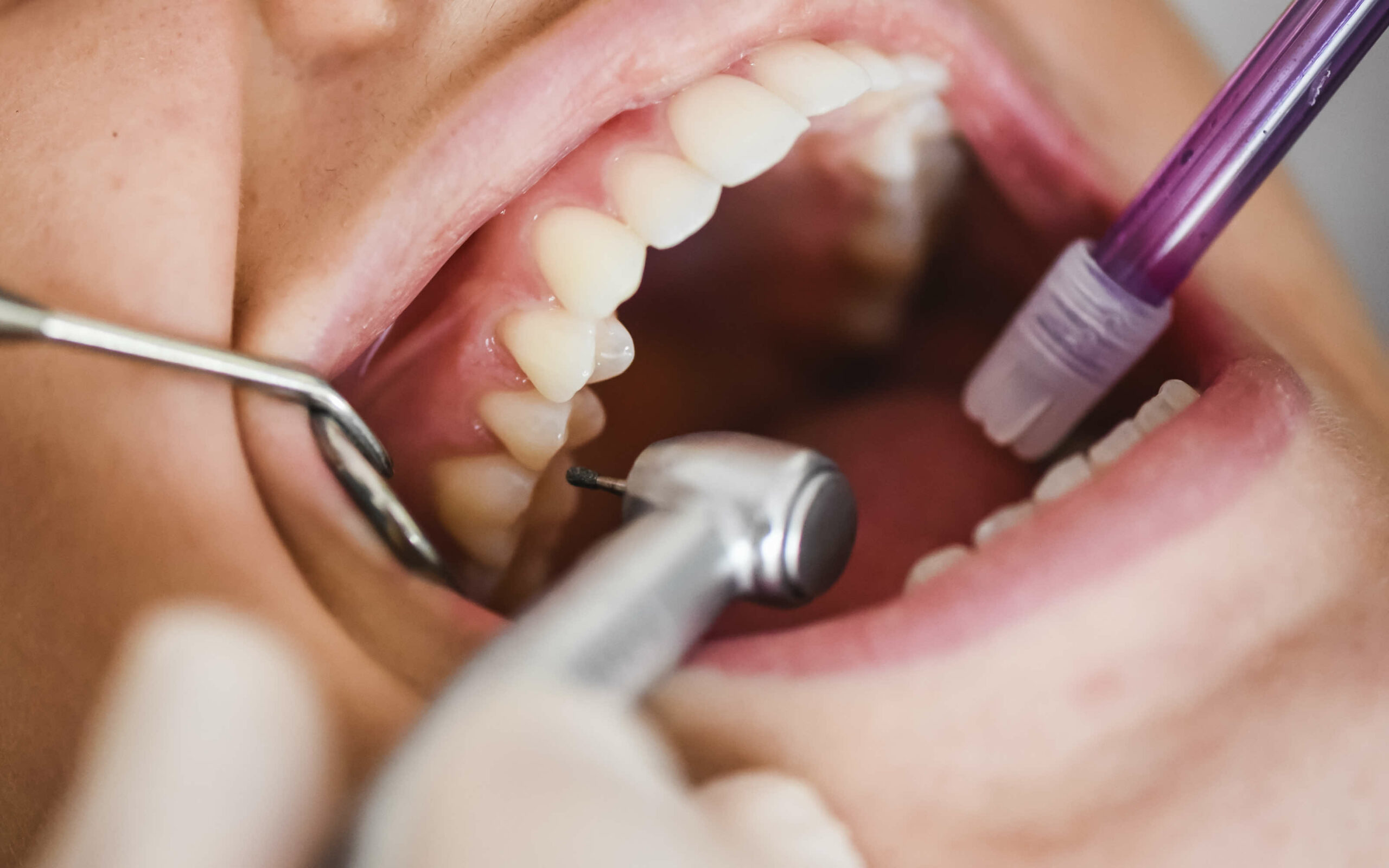 Como ocorre a formação do Cálculo Dental?