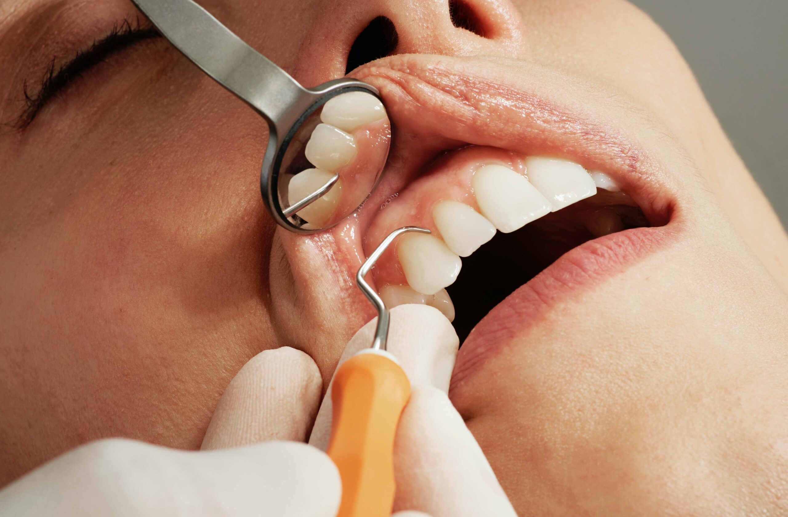 Limpeza de dente com ultrassom: saiba quando fazer