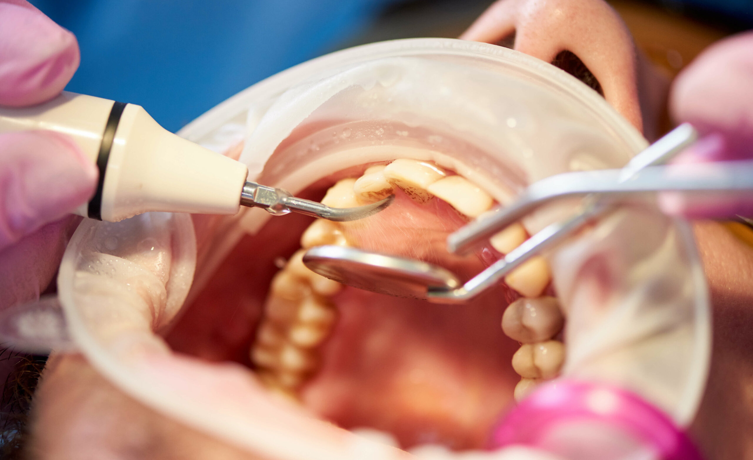 O que é cálculo dental generalizado? Descubra como tratar!