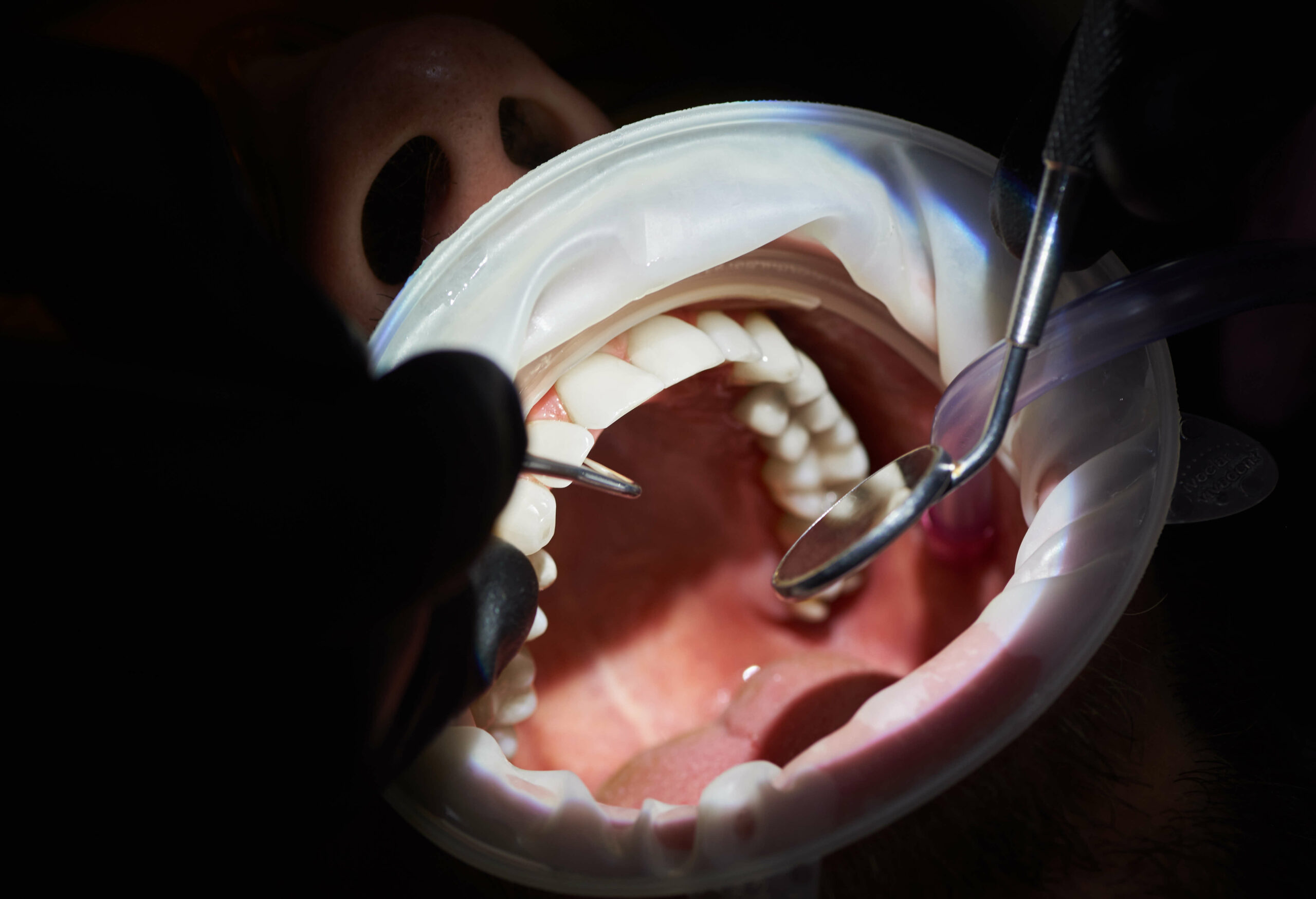 Ultrassom na odontologia: 7 usos na área de endodontia