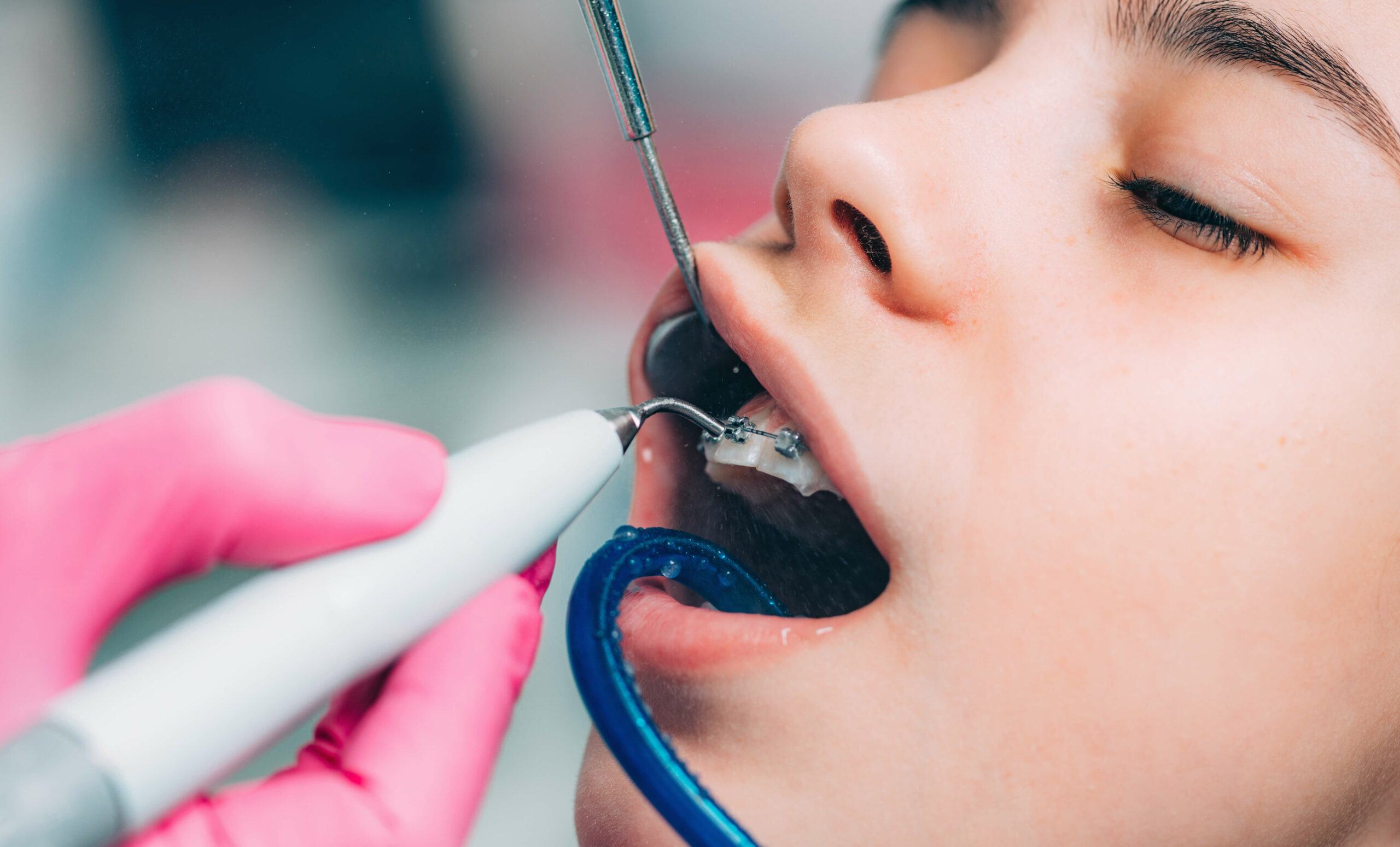 Ultrassom Odontológico: Entenda para que serve e quais são suas principais vantagens