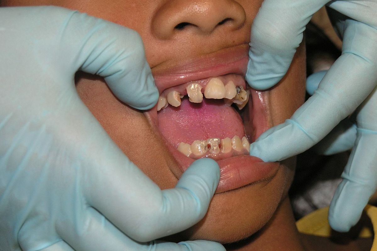 Doenças no dente podem causar perda dentária? Saiba quais você deve evitar