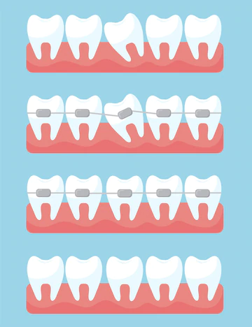 Alinhamento dos dentes: veja como funciona e 6 vantagens!