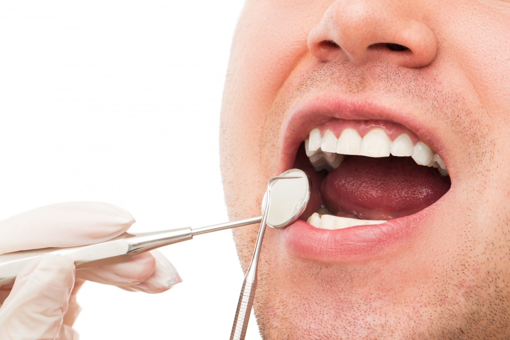 Como ocorre a formação de tártaro nos dentes? Saiba tudo aqui